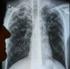 Zur Entwicklung der Tuberkulose in Deutschland und in der Stadt Bremen