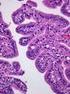 Bedeutung des Tumorbefallmusters beim epithelialen Ovarialkarzinom