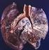 Hirnmetastasen beim Lungenkarzinom