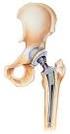 Das künstliche Hüftgelenk