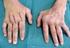Operative Therapie an der rheumatischen Hand
