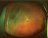 Weitwinkel-Fundusautofluoreszenz bei Patienten mit Uveitis posterior