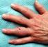 Arthrosen der Fingergelenke. Ursachen und Behandlungsmöglichkeiten