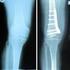 Achsenkorrektur = Umstellungsosteotomie am Kniegelenk