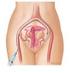 Die Embolisation der Arteria uterina zur Therapie des symptomatischen Uterus myomatosus