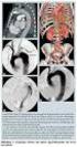 Stentgraftimplantation bei Erkrankungen der Aorta ascendens